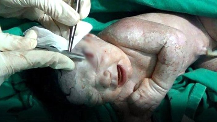 Doktorlar anne karnında ölen bebeği hayata döndürdü