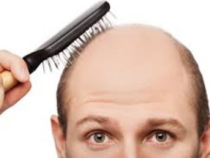 erkek saç dökülmesi