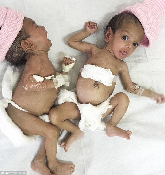 Hindistan'da yapışık bebekler ameliyatla ayrıldı