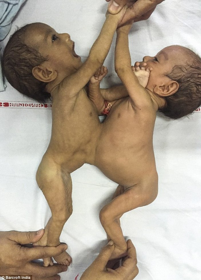 Hindistan'da yapışık bebekler ameliyatla ayrıldı