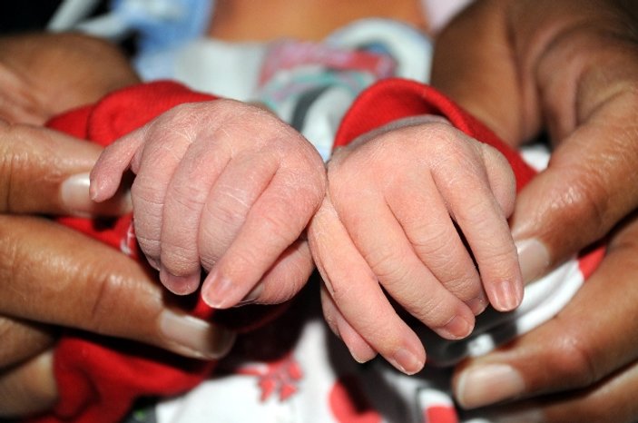 Şanlıurfa'da 24 parmaklı bebek doğdu