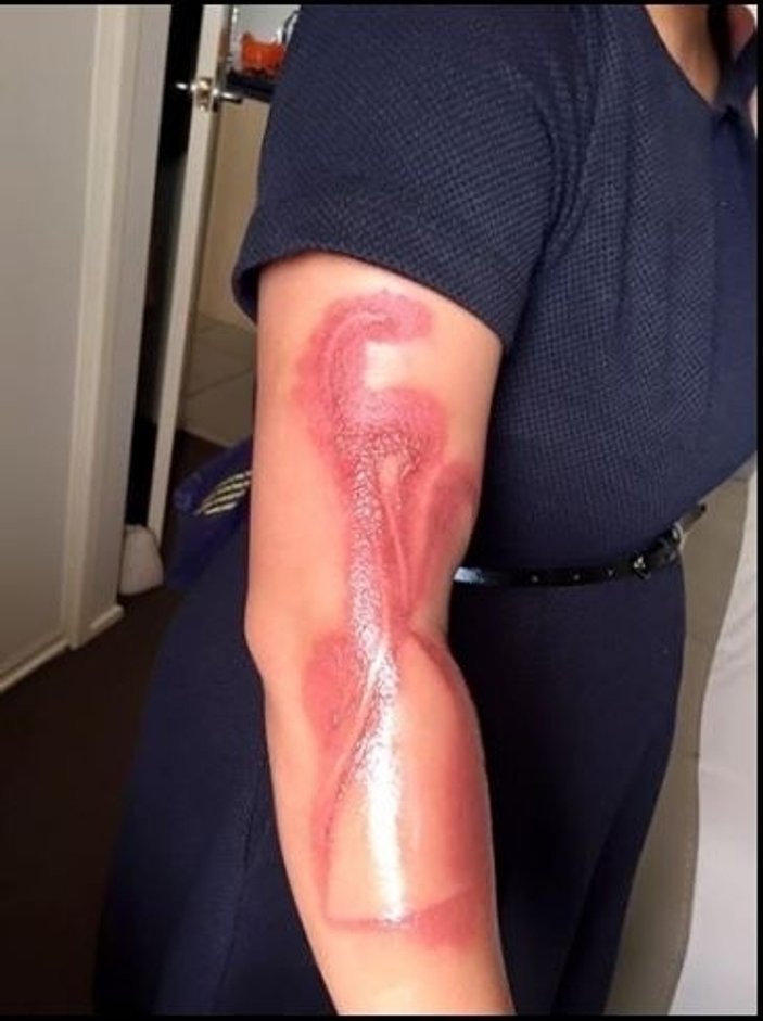 iPhone 7 ile uyuyakalan kadının kolu yandı