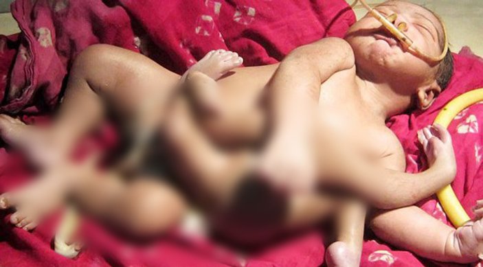 4 ayaklı 2 omurgalı doğan bebek ameliyat edildi