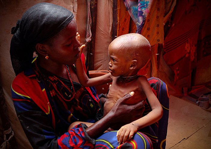 Somali'de kolera virüsü 343 can aldı