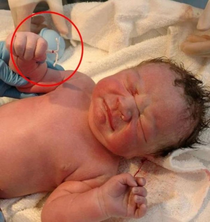 ABD'de bir bebek, elinde spiralle doğdu