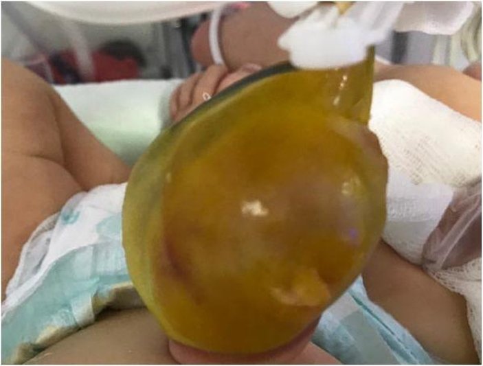 Eskişehir'de 2 günlük bebek ameliyat edildi