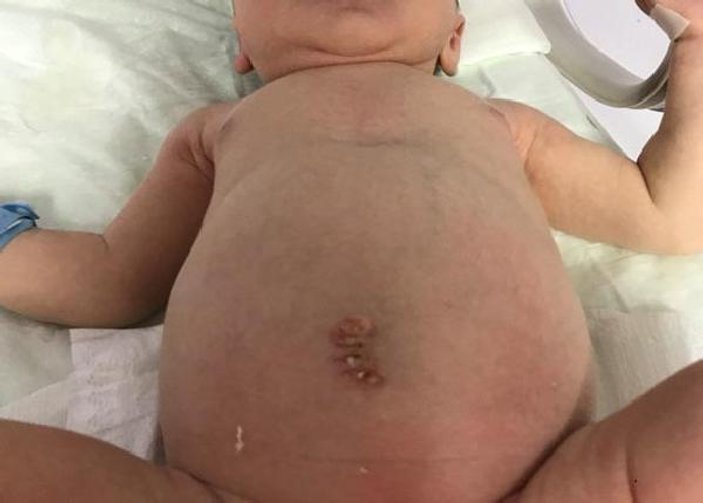 Eskişehir'de 2 günlük bebek ameliyat edildi