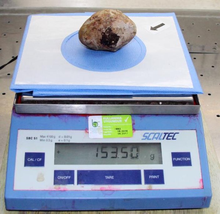 Burdur'da bir adamın mesanesinden 153 gramlık taş çıktı