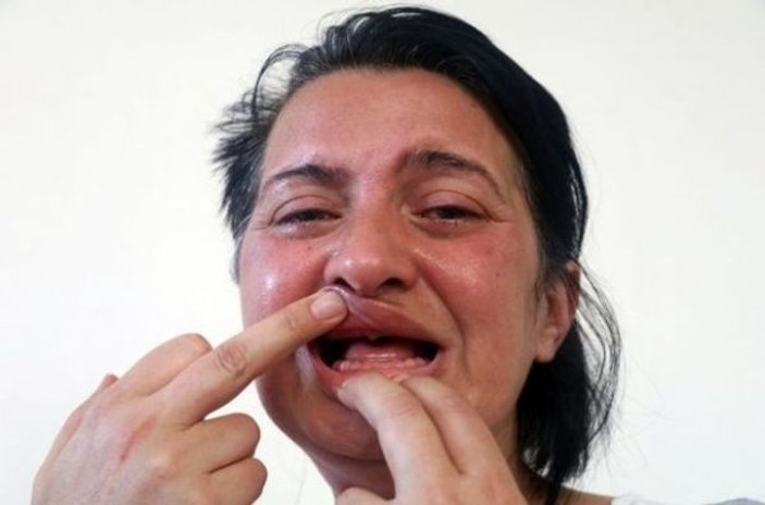 32 dişini de kaybeden kadın yeniden tedavi görüyor