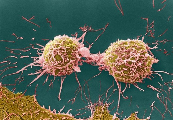 Kanser tedavisi için yeni bir ilaç geliştiriliyor