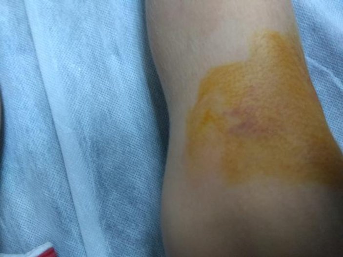 Zonguldak'ta 4 yaşındaki çocuğa yılan saldırdı