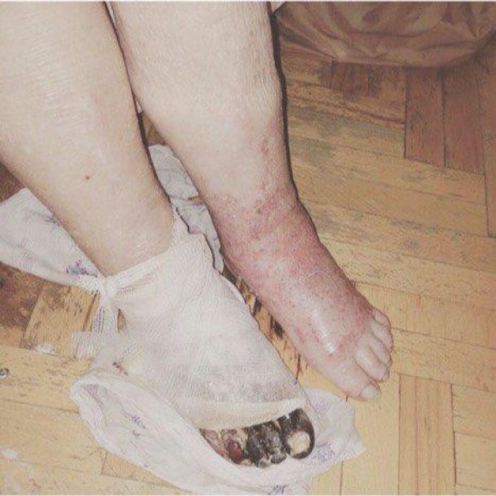 Rusya’da yanlış ayağı kesilen hasta öldü