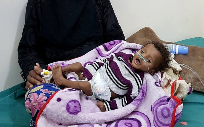 Yemen'de kıtlık en çok çocukları vuruyor