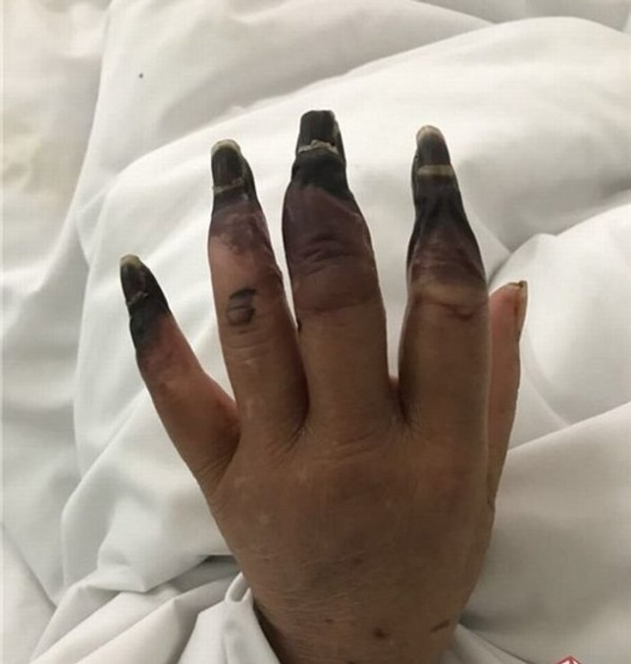 Elindeki kesik nedeniyle 8 parmağını birden kaybediyordu