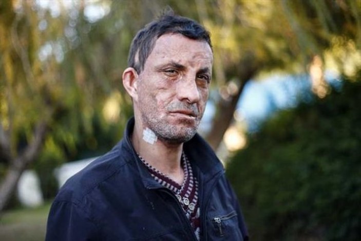 Türkiye'nin ilk yüz nakli olan hastası: Rüya gibi