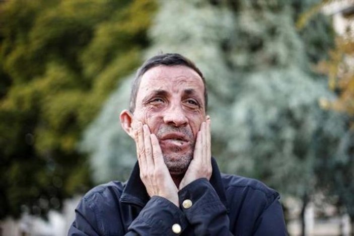 Türkiye'nin ilk yüz nakli olan hastası: Rüya gibi