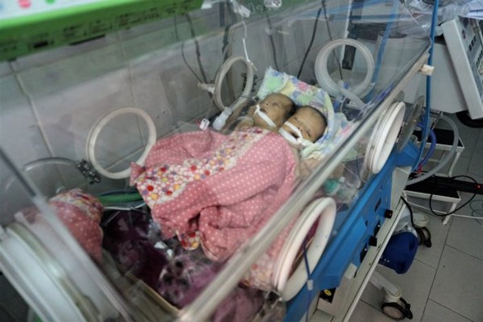 Yemenli yapışık ikizler kurtarılamadı