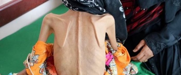 Yemenli kız bir deri bir kemik kaldı