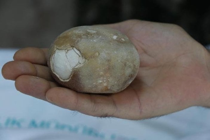 Samsun'da 37 yıllık doktoru şaşırtan taş