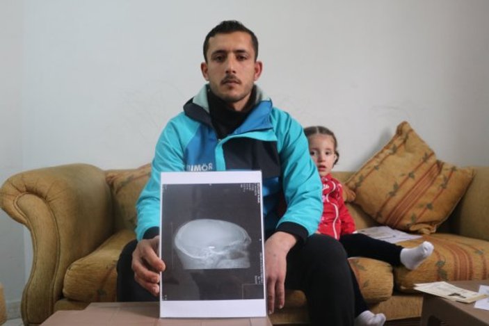 Suriye’deki savaş mağduru kafasındaki mermiyle yaşıyor