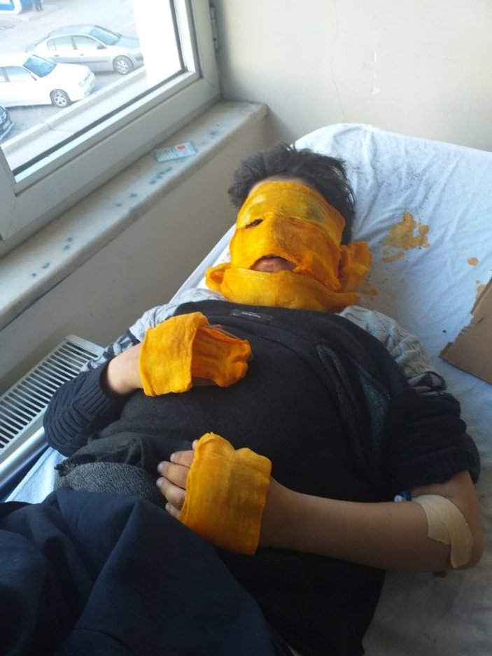 Erzurum'da 11 yaşındaki çocuğun yüzü yandı