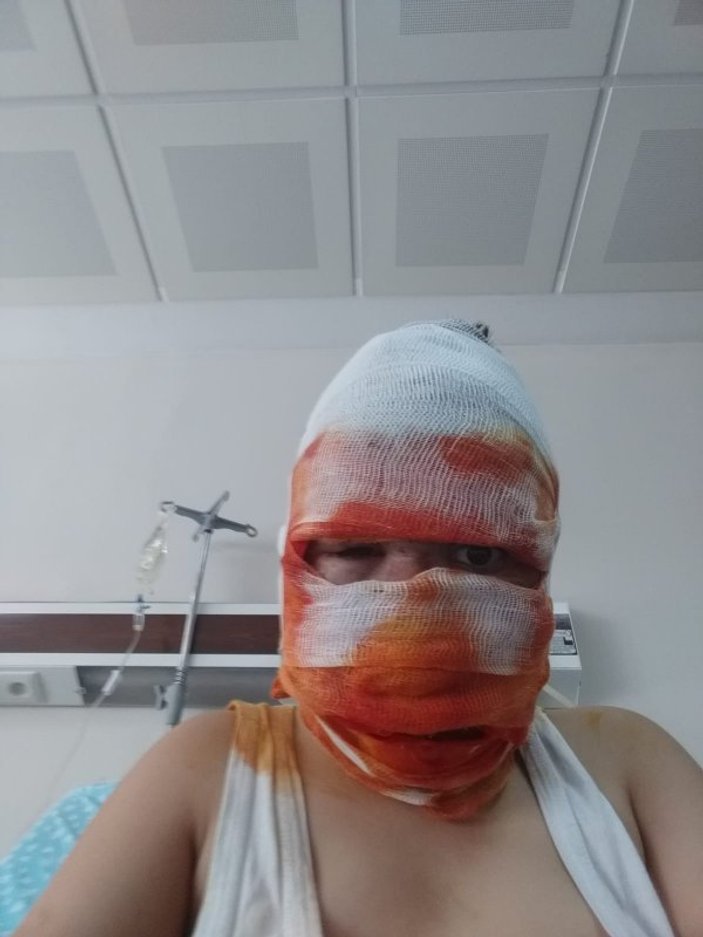 Erzurum'da 11 yaşındaki çocuğun yüzü yandı
