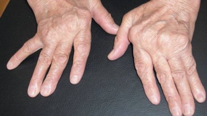 Romatoid artrit nedir