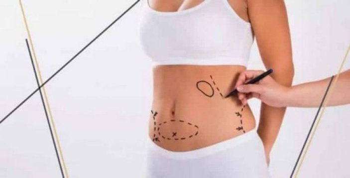 Liposuction nedir