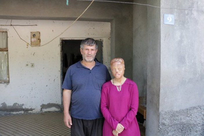 Kahramanmaraş'ta 20 yaşında yüz nakli bekliyor