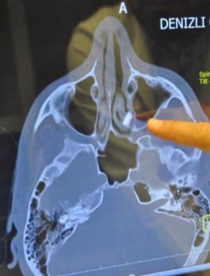 Denizli'de yaşayan öğrenci burnundaki diş ile 6 yıl yaşamış