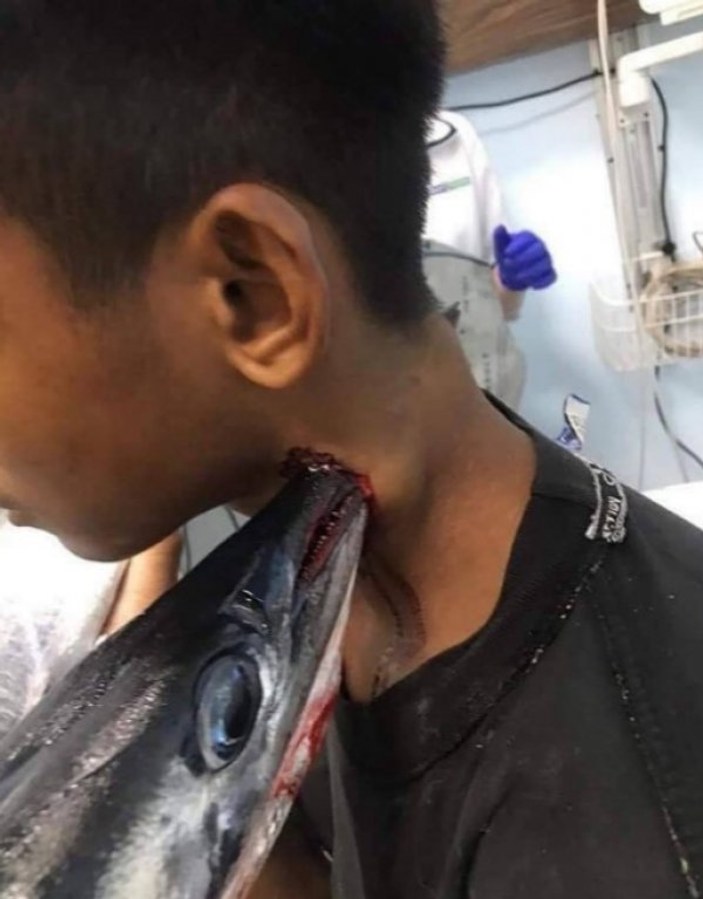 İğne balığı saldırısında bir çocuk yaralandı