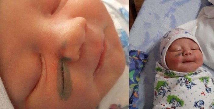 Rusya'da doktorlar doğum sırasında bebeğin yüzünü kesti