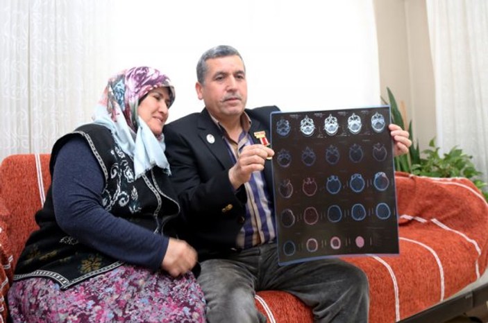 Gazi, 28 yıldır başındaki 14 şarapnel parçasıyla yaşıyor