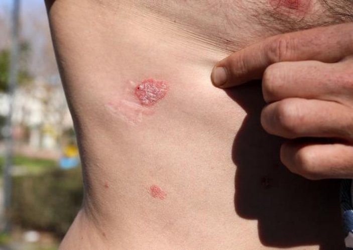 Antalya'da tabancayla vurulan fırıncı ustasının hayatı karardı