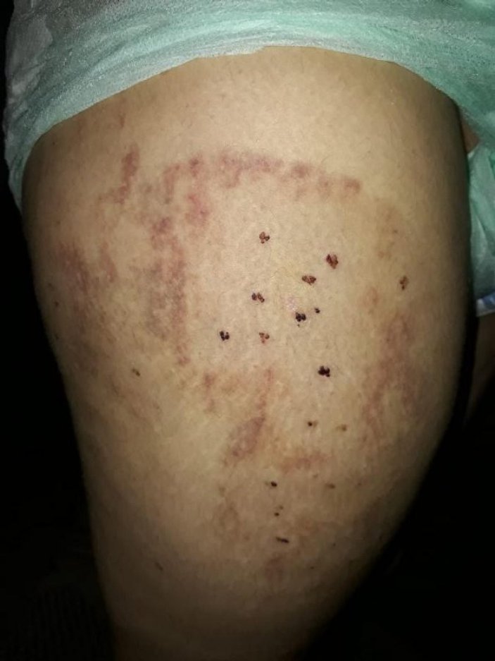 Adana'da otizmli kızın dövüldüğü iddiası