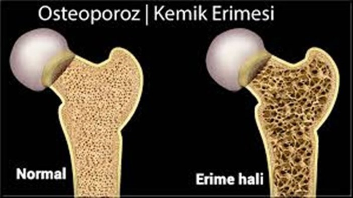 Osteoporoz nedir