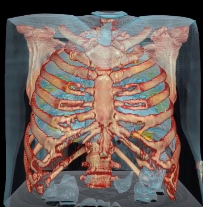 ABD'de korona bulunan akciğerin 3D görüntüsü paylaşıldı