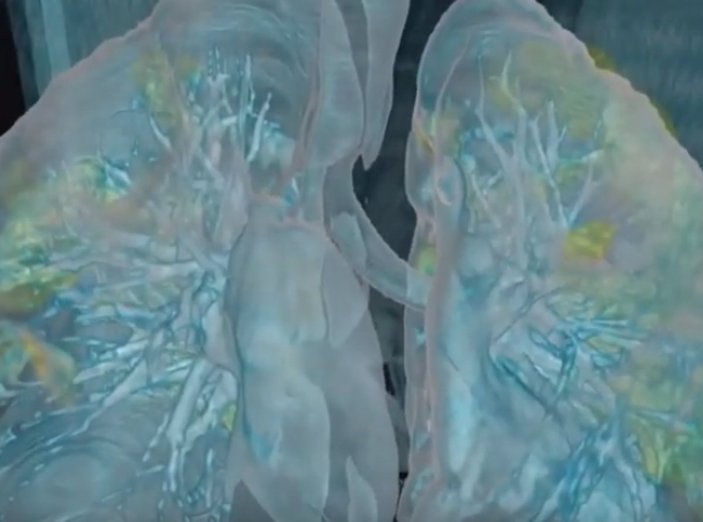 ABD'de korona bulunan akciğerin 3D görüntüsü paylaşıldı