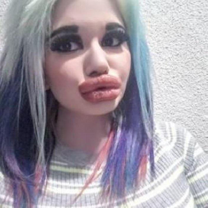 Bulgaristan'da genç kız, 20'den fazla dudak dolgusu yaptırdı