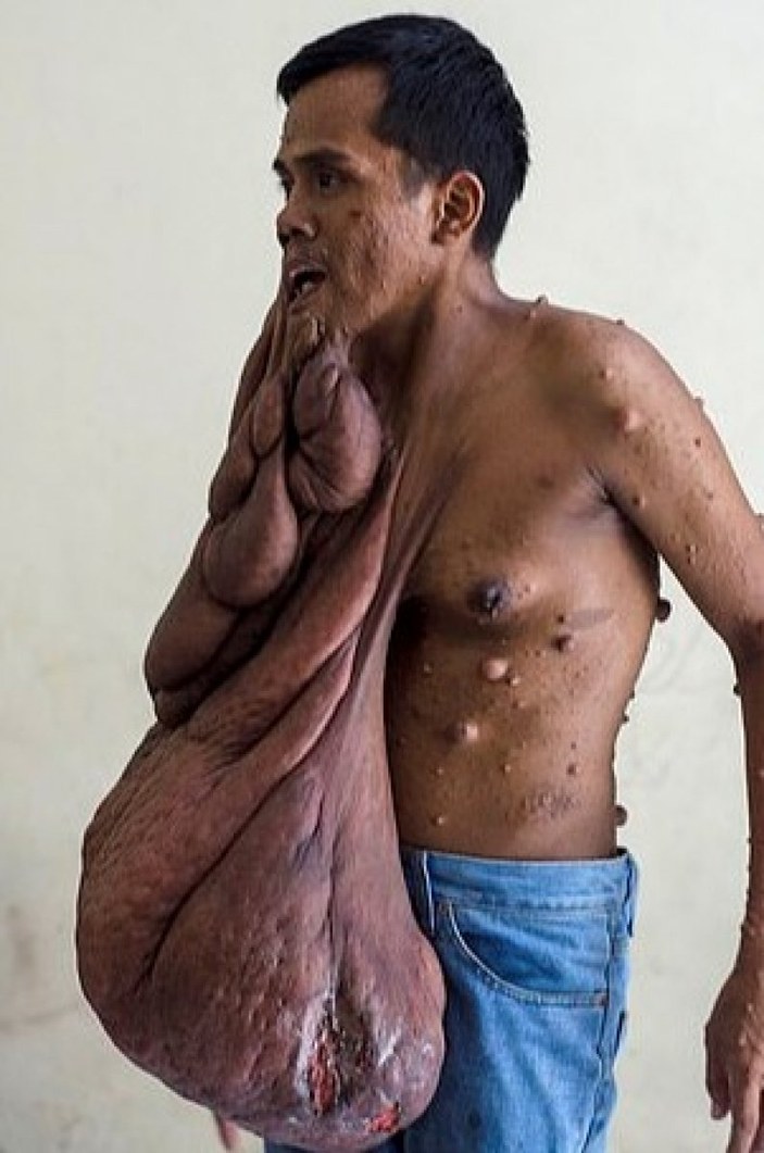 Endonezya'da talihsiz adam 40 kiloluk tümörle savaşıyor
