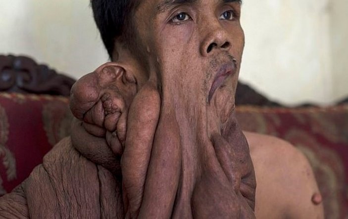 Endonezya'da talihsiz adam 40 kiloluk tümörle savaşıyor