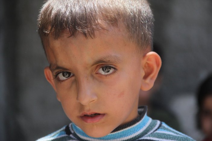Kalbi delik olan Suriyeli Tarık yardım bekliyor