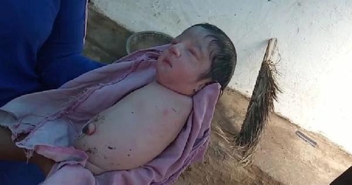 Hindistan’da kolları ve bacakları olmadan doğan bebek