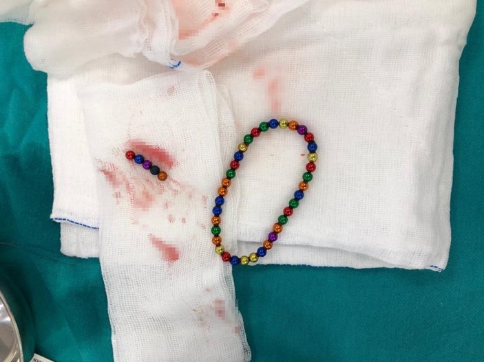 9 yaşındaki çocuğun midesinden mıknatıs topları çıkarıldı