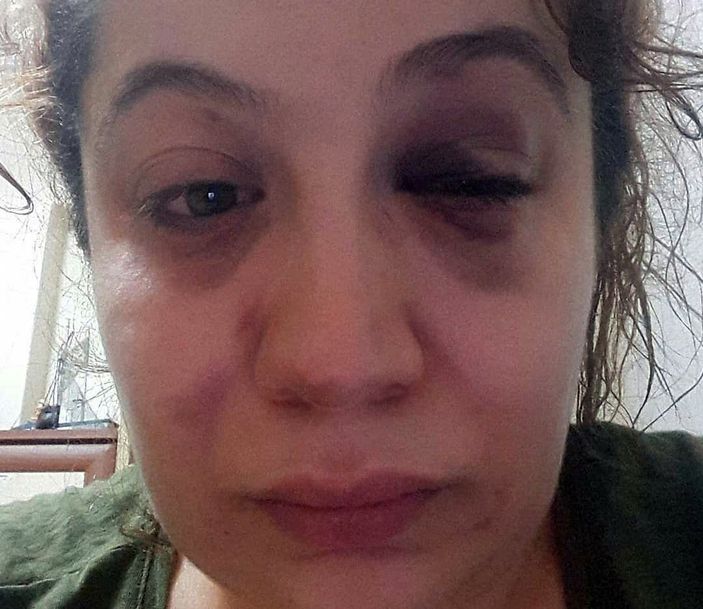 İstanbul'da eski eşinden şiddet gördü, yardım bekliyor