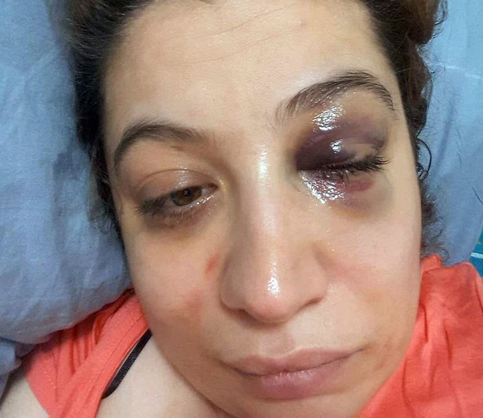 İstanbul'da eski eşinden şiddet gördü, yardım bekliyor