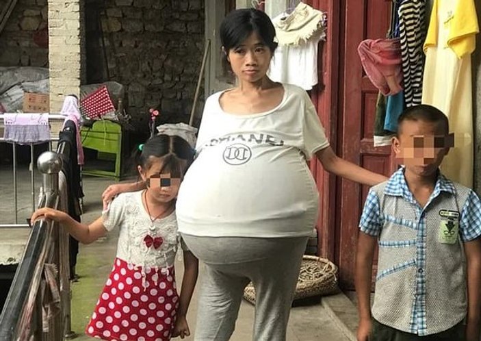 Karnında 20 kiloluk kütle taşıyan Çinli kadın
