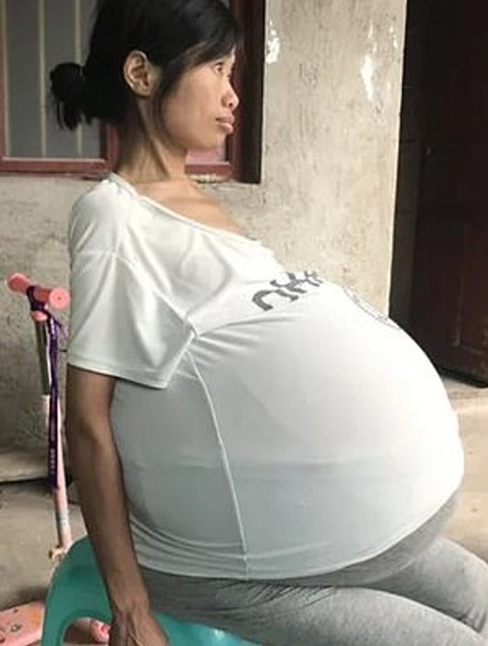 Karnında 20 kiloluk kütle taşıyan Çinli kadın