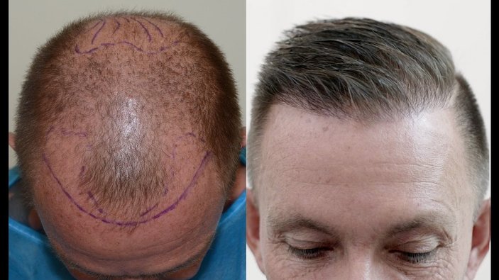 Saç ekimi sonrası iyileşme süreci ve önemli detaylar