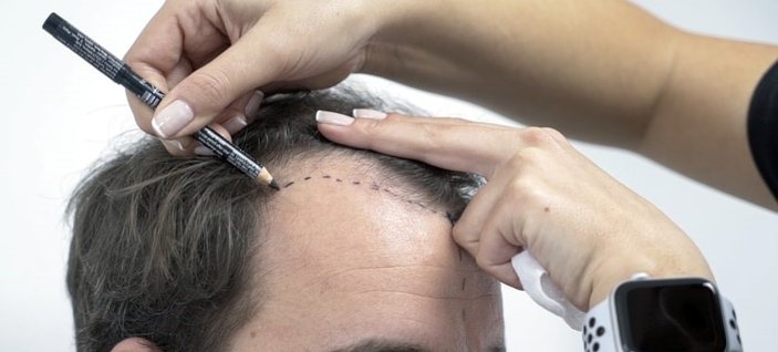 Saç ekimi sonrası iyileşme süreci ve önemli detaylar